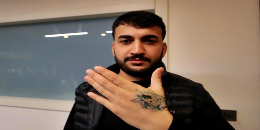 Dövme Sildirme Kabusu: Genç Adamın Elinde Dokular Öldü